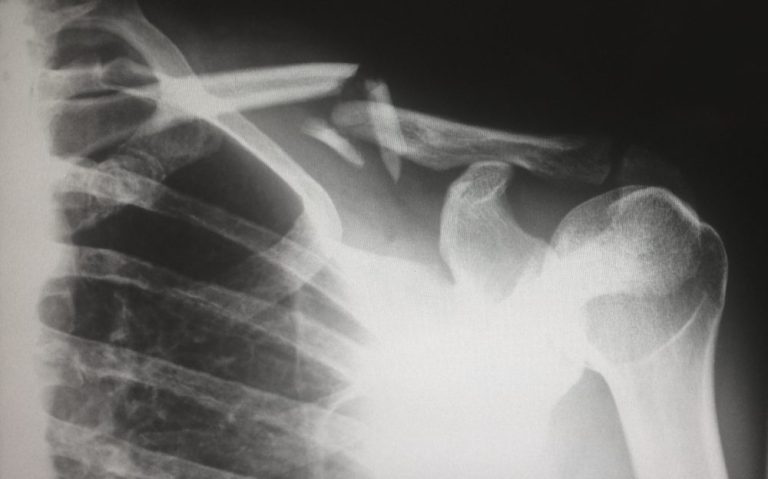 Fractured Clavicle