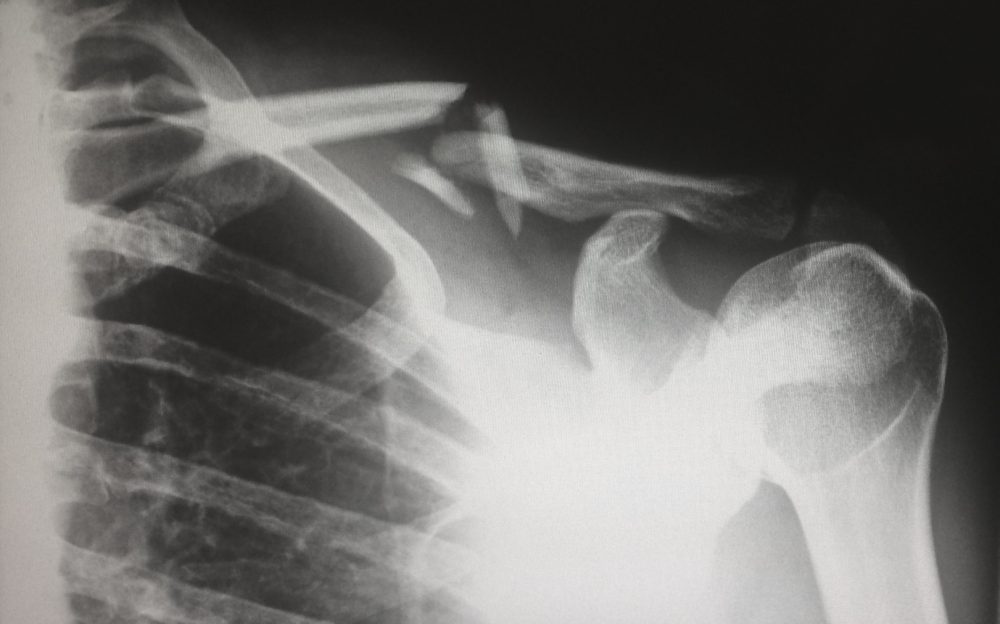 A Guide to Calculating a Personal Injury Claim